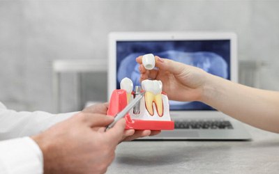 a dentist holding a model of dental implants