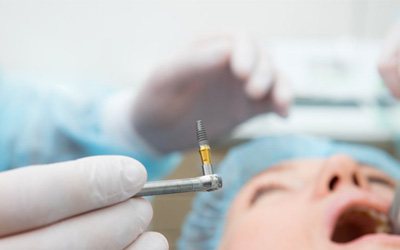 a dentist holding a dental implant during placement surgery