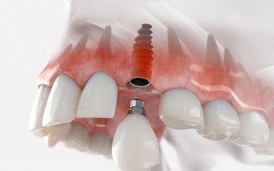 a 3D illustration of a dental implant and crown