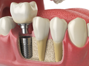 3D dental implant