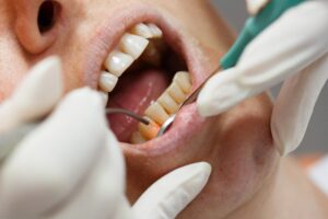 Dentist treating patient’s gums with dental laser